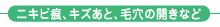 ニキビ痕、キズあと、毛穴の開きなど ニキビ痕、キズあと、毛穴の開きなど