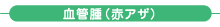 血管腫(赤アザ) 血管腫(赤アザ)